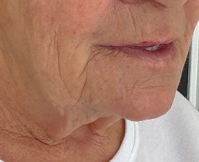 Sylfirm X — Lower face and neck — before treatment