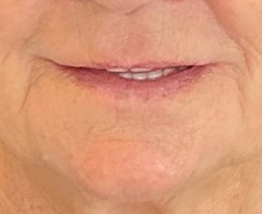 Sylfirm X — Around the mouth — after treatment