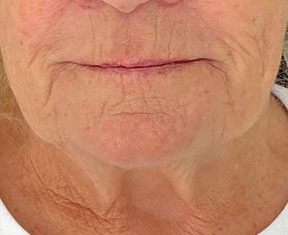 Sylfirm X — Around the mouth — before treatment
