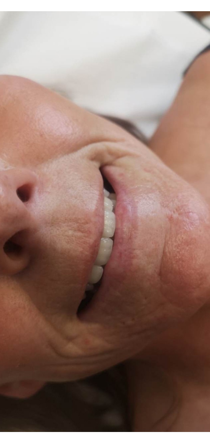 Dermal Fillers — Lines around the mouth — after treatment