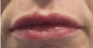 Dermal Fillers — Lip enhancement — after treatment