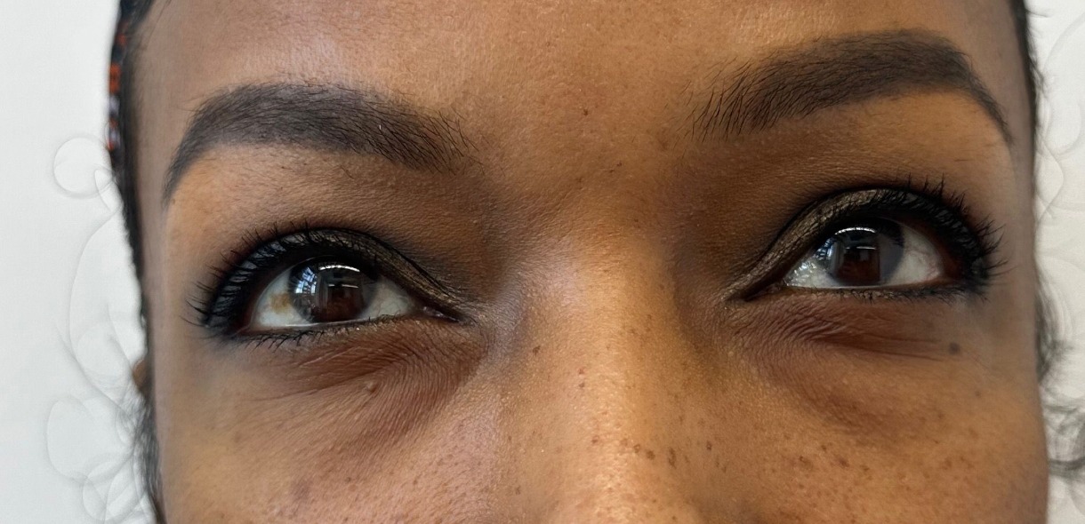 Skin Boosters — Under-eye area — before treatment